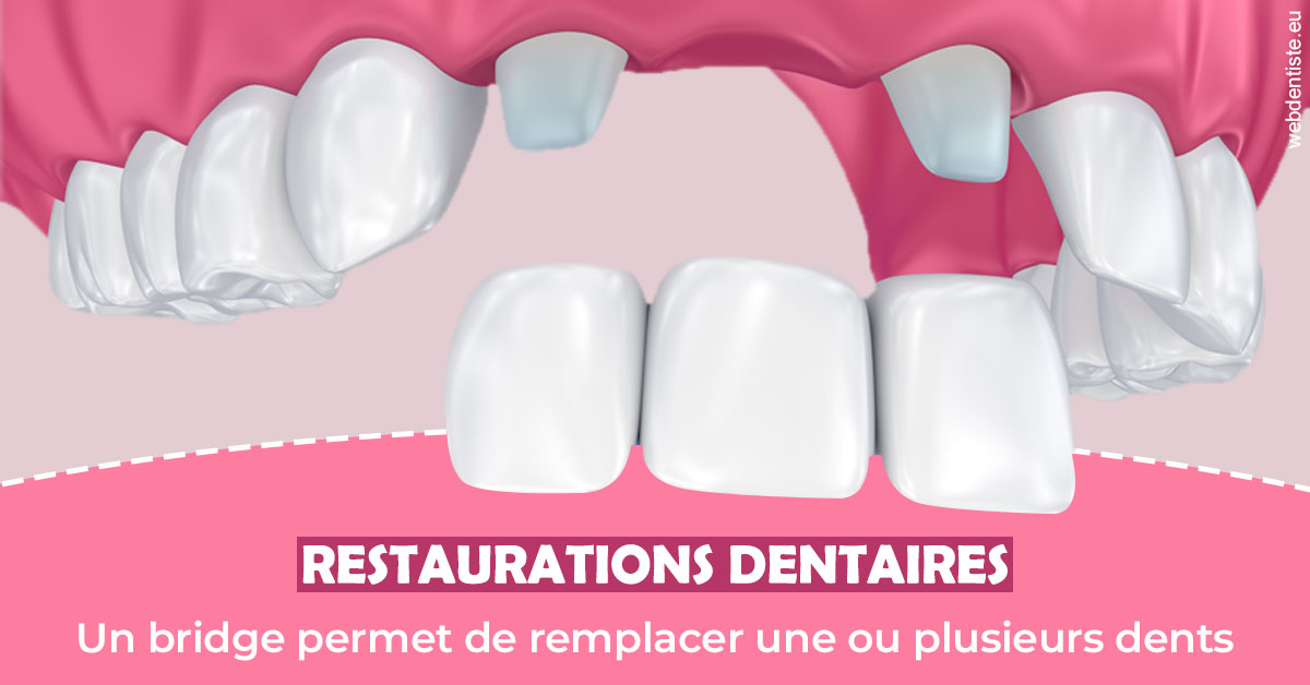 https://www.dr-renard-orthodontiste.fr/Bridge remplacer dents 2