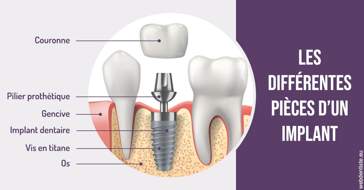 https://www.dr-renard-orthodontiste.fr/Les différentes pièces d’un implant 2
