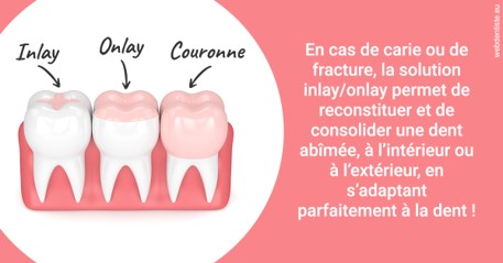 https://www.dr-renard-orthodontiste.fr/L'INLAY ou l'ONLAY 2