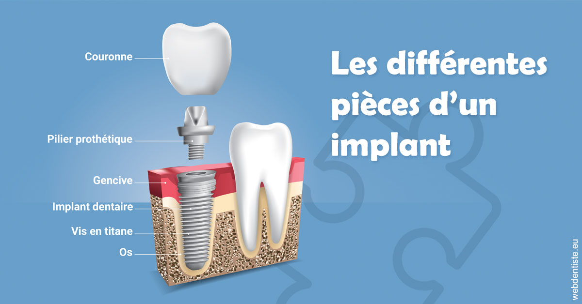 https://www.dr-renard-orthodontiste.fr/Les différentes pièces d’un implant 1